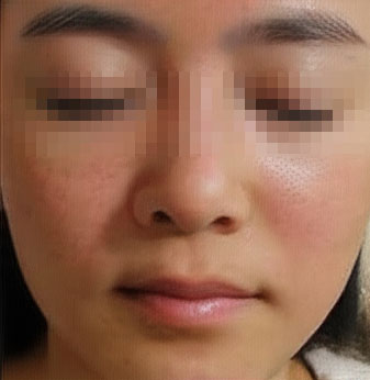 지루성피부염