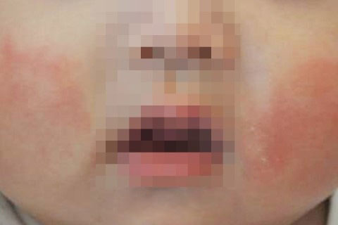 영아기 아토피 이미지