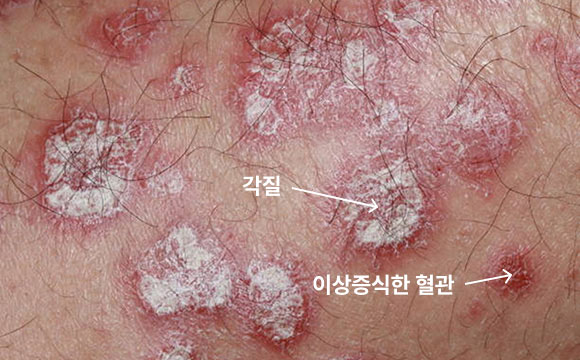 건선 이미지