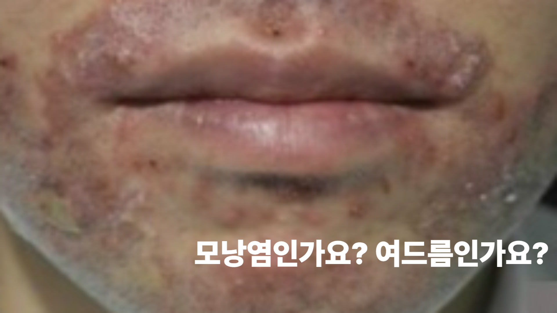 얼굴모낭염,수염 주변 여드름인가요, 모낭염인가요?