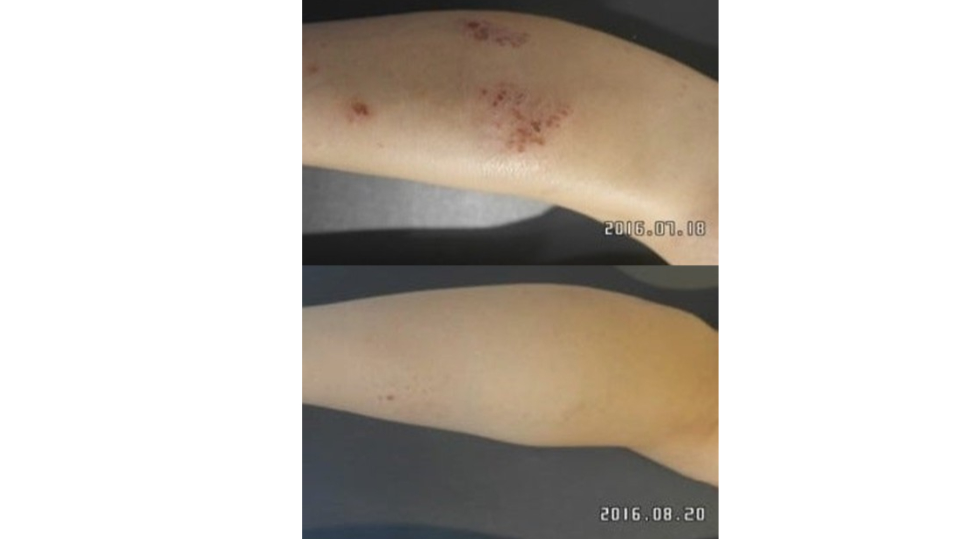 종아리화폐상습진,허벅지화폐상습진 여기저기 옮겨다녀요
