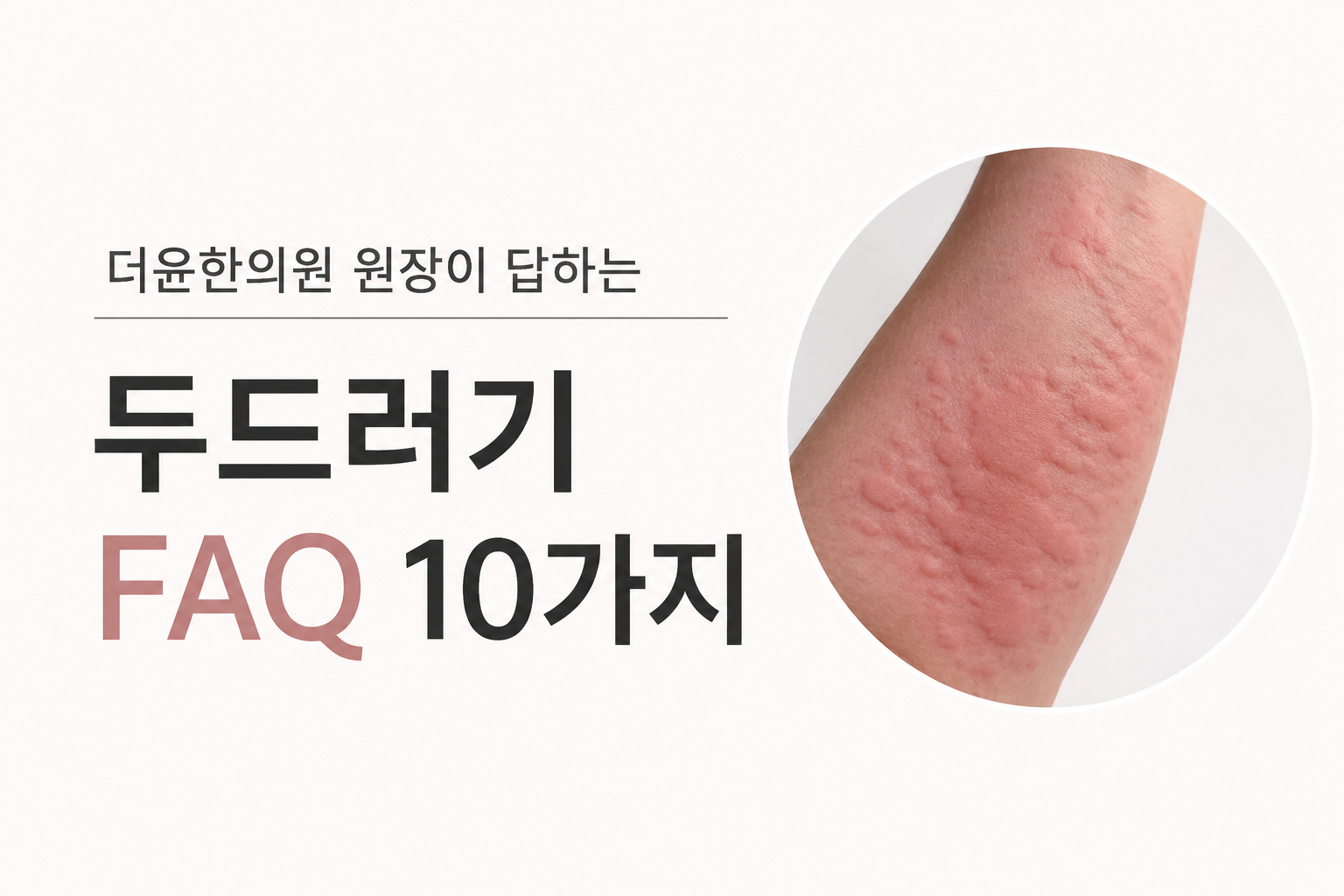 만성 두드러기, 왜 생길까요? 원인부터 치료와 관리까지 자주 묻는 질문 10가지