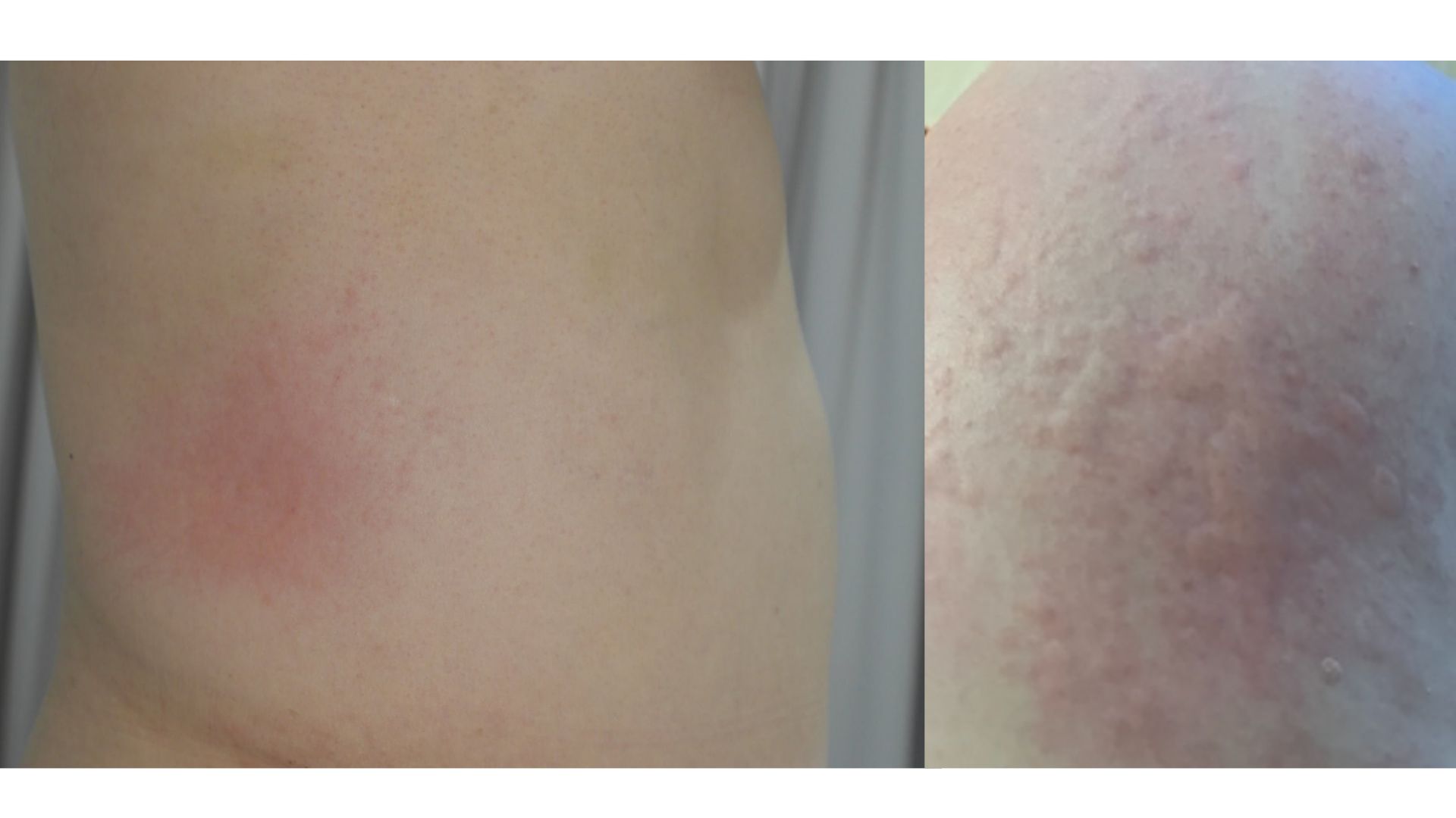 초등학생인데 2년째 두드러기가 반복돼요, 초등학생,중학생의 두드러기 원인은