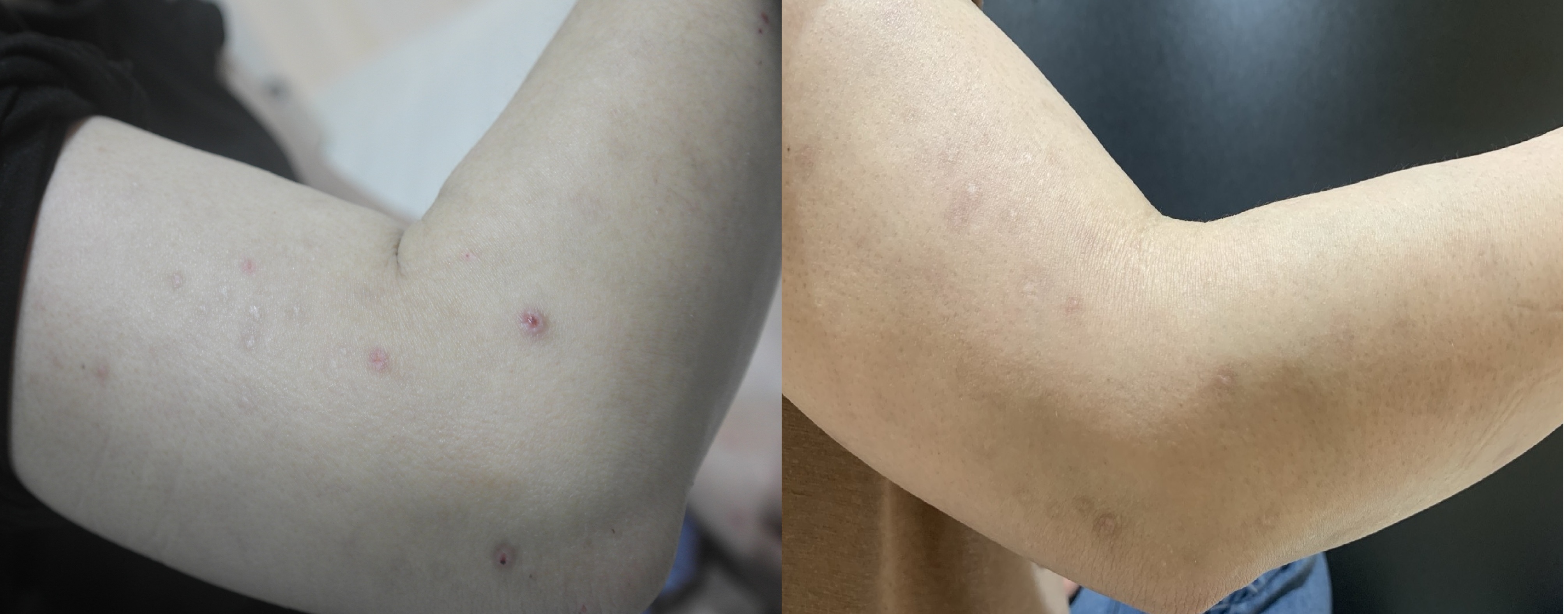 질환명:결절성양진/연령:40대/직업:간호사