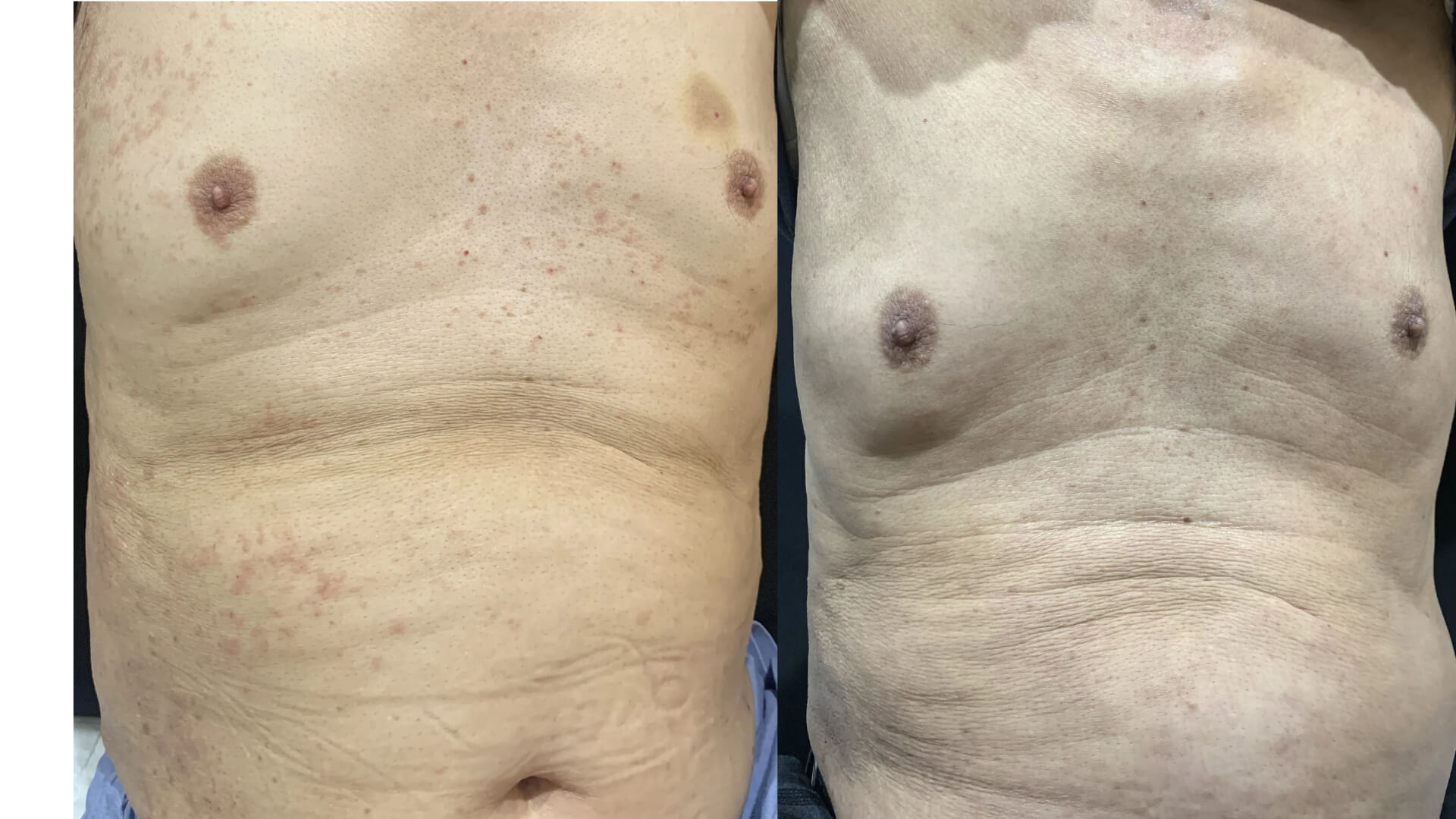 갑자기 생긴 전신 가려움으로 1년넘게 스테로이드 연고를 썼던 70대  습진환자 3개월 집중치료기