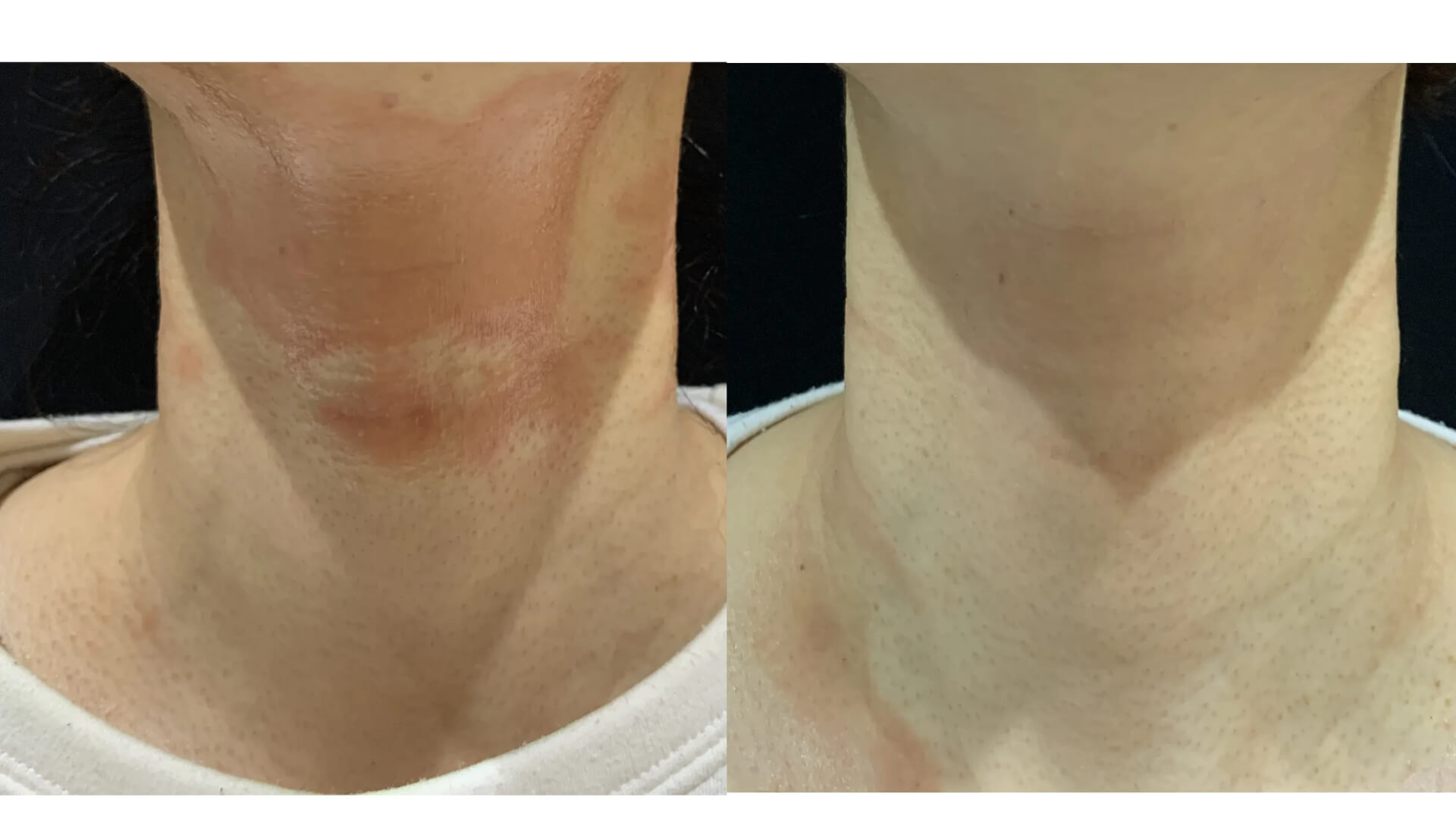 [아토피피부염/40대/직장인] 갑자기 생긴 성인얼굴아토피도 좋아집니다