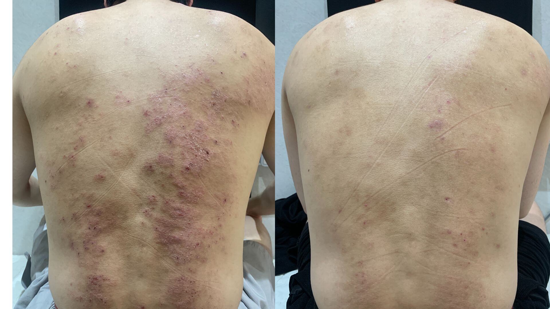 [30대/아토피/직장인]오랫동안 스테로이드를 사용했지만 이제 듣지 않는 아토피.